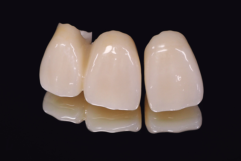 セラミックのメリット